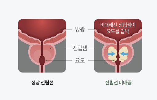 카리토 포텐, 전립선 건강에 혁신적인 변화를 일으킨다!