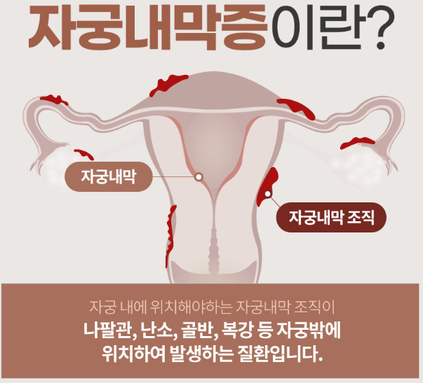자궁 내막증 통증, '이것'만 하면 완화됩니다!